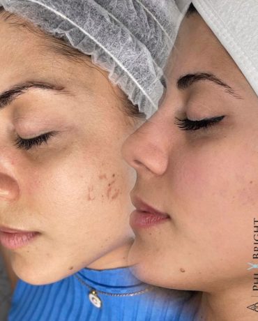 micropigmentación en Madrid en GB SKINCARE STUDIO - Grey Baez